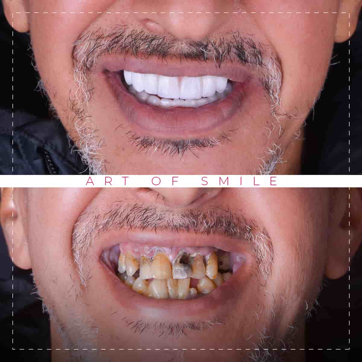 Ästhetische Zahnheilkunde vorher und nachher, Zahnreinigung, Hollywood-Lächeln, Zahnimplantate