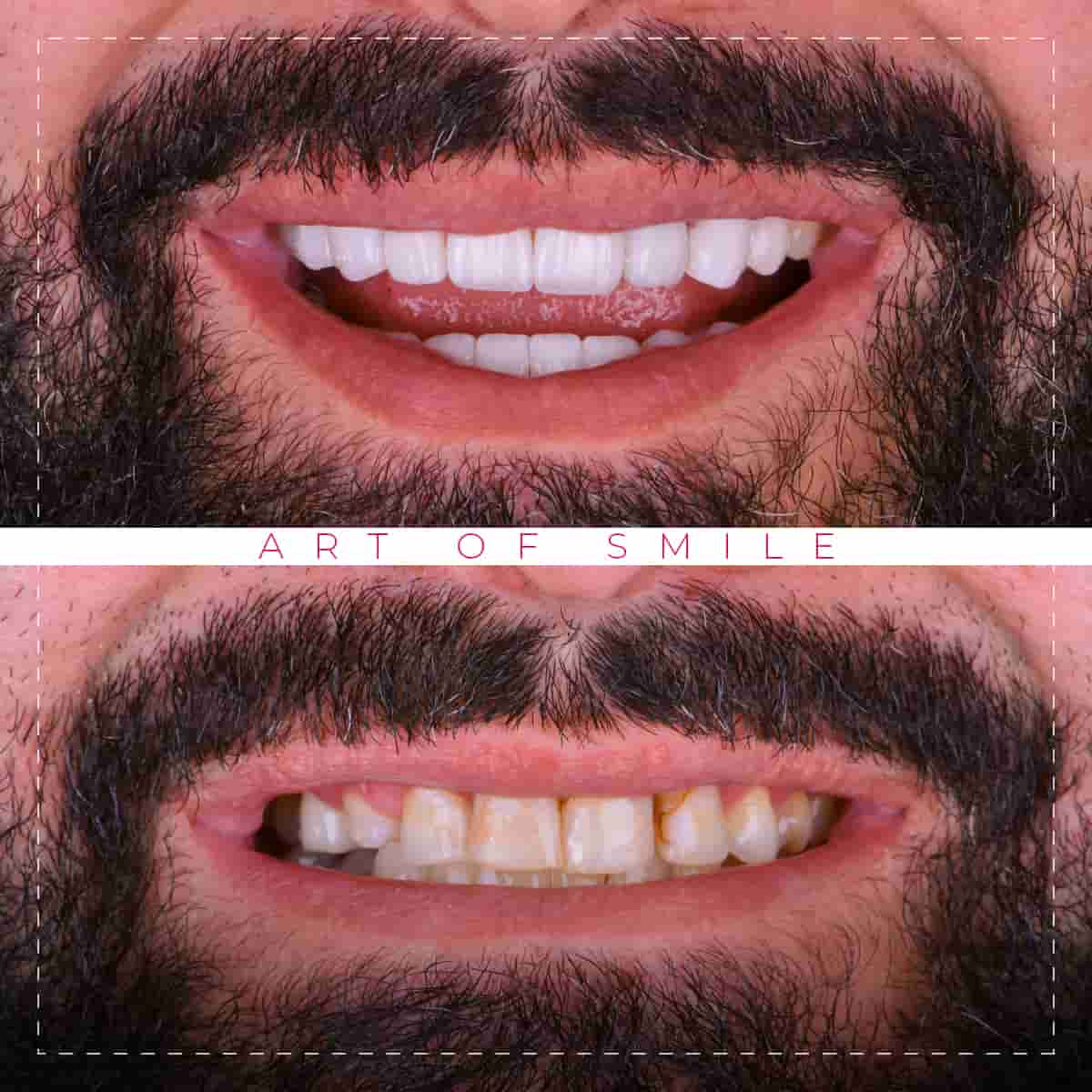 Ästhetische Zahnheilkunde vorher und nachher, Zahnreinigung, Hollywood-Lächeln, Zahnimplantate