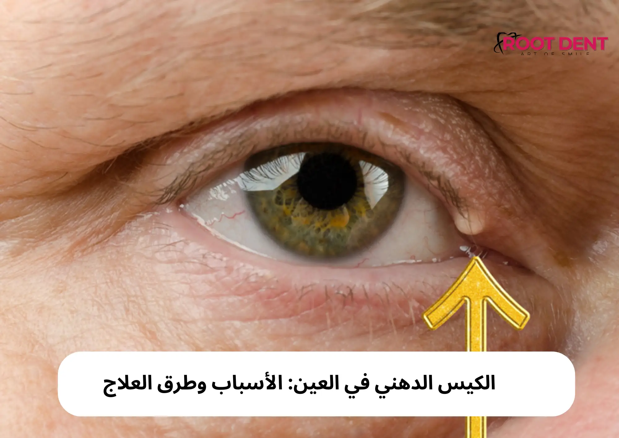 الكيس الدهني في العين: الأسباب وطرق العلاج